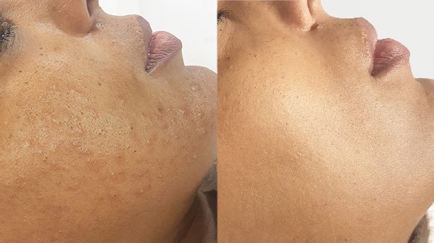 Peeling químico Azelaic Skin PEEL 50 ml