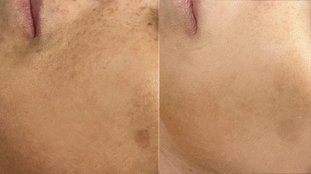 Peeling químico Resorcinol Skin PEEL 50 ml